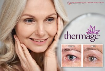 Thermage Skin Tightening for Aging & Sagging Eyes