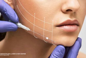 PDO Thread Lift: Your Non-Surgical Facelift in Cincinnati, Ohio