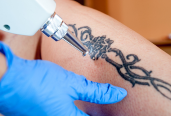 How Many Laser Sessions Does It Take to Remove a Tattoo?