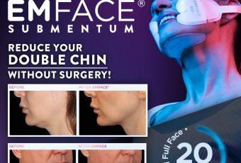 EMFACE Submentum Double Chin Treatment in Cincinnati, Ohio