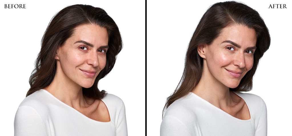 SKINVIVE Microdroplet Skin Booster Injections | Cincinnati, Ohio