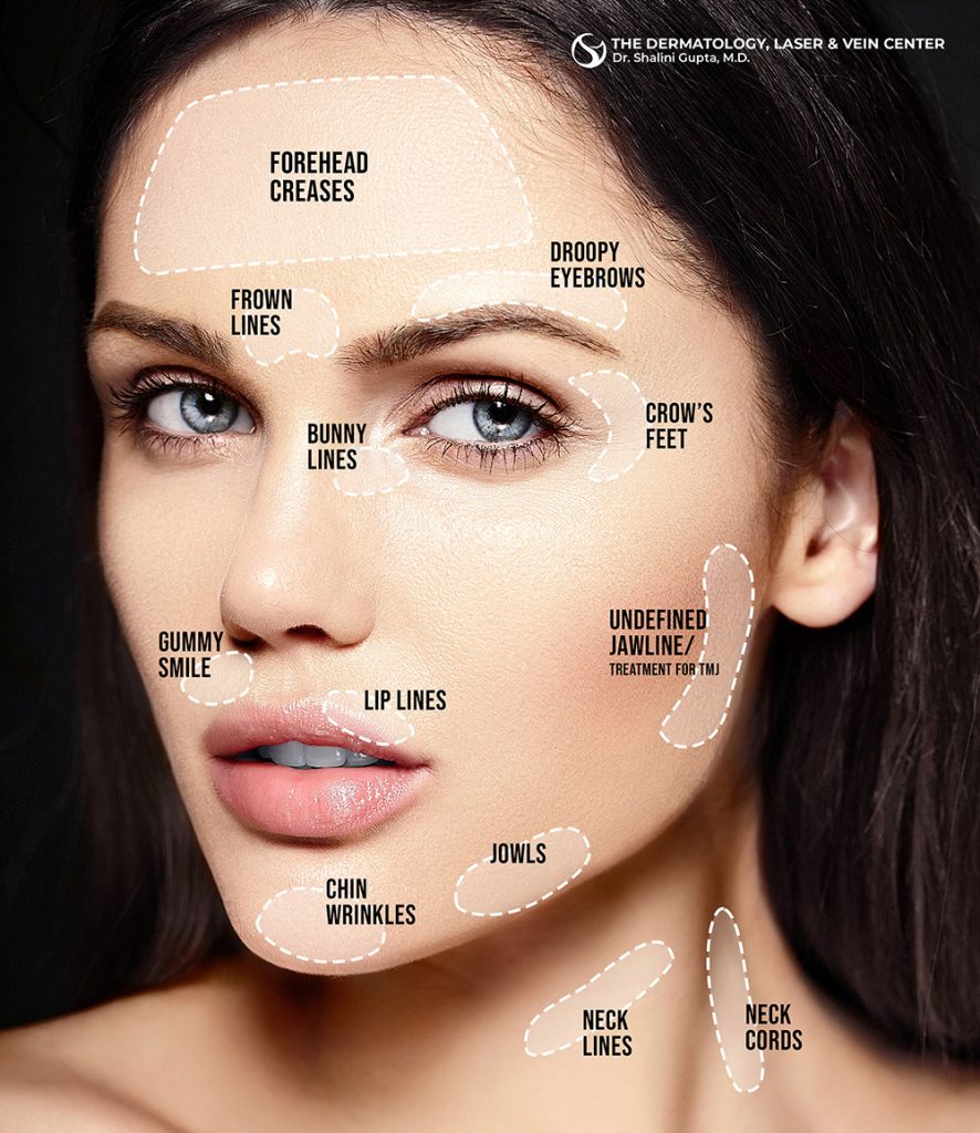 Botox Areas Treatment Guide Cincinnati