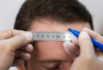 Discover the Best Hair Restoration in Cincinnati, Ohio