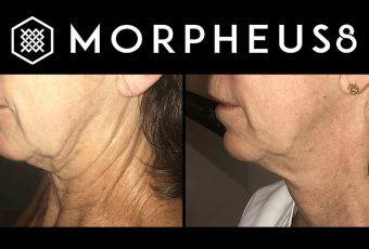 How to Tighten Skin with Morpheus8 in Cincinnati, Ohio