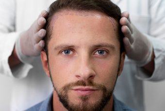 Why You Should Choose SmartGraft Hair Restoration Over Traveling Abroad for Hair Transplants