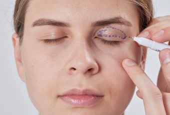 Eyelid Surgery Cincinnati: Rejuvenate Your Facial Appearance
