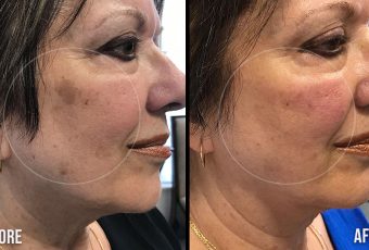 Most Effective Brown Spot Removal with BBL Laser Treatments in Cincinnati, Ohio