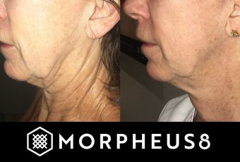 Resurface and Revitalize Your Skin with Morpheus8 in Cincinnati, Ohio