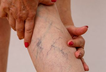 Sclerotherapy Explained: The Non-Surgical Fix for Varicose Veins