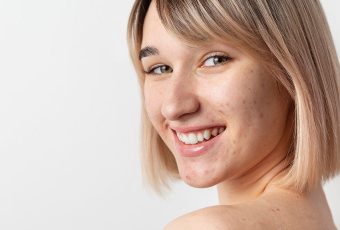 Transform Your Skin with Microneedling for Acne Scar Removal in Cincinnati, Ohio