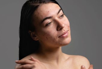 Can Fillers Be Used to Fix Acne Scars?