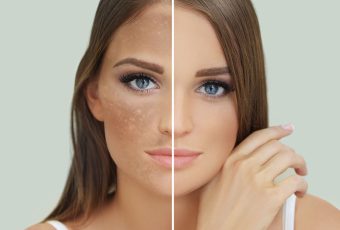 Can Hyperpigmentation Be Removed by Laser?