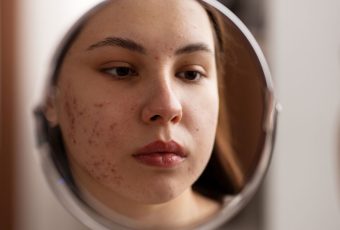 Can Laser Skin Resurfacing Treat Acne?