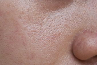 Can Laser Treatment Fix Large Pores?