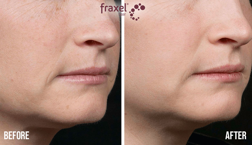 Fraxel Skin Resurfacing in Cincinnati Ohio The Dermatology Laser and Vein Center Dr Shalini Gupta