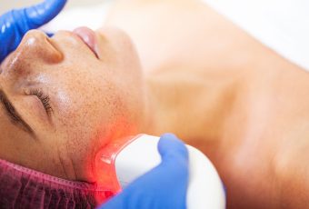 How Many Sessions of Laser Resurfacing Do I Need?