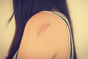 Best Laser Skin Resurfacing for Scar Revision