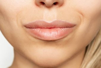 What Is the Most Effective Treatment for Marionette Lines?