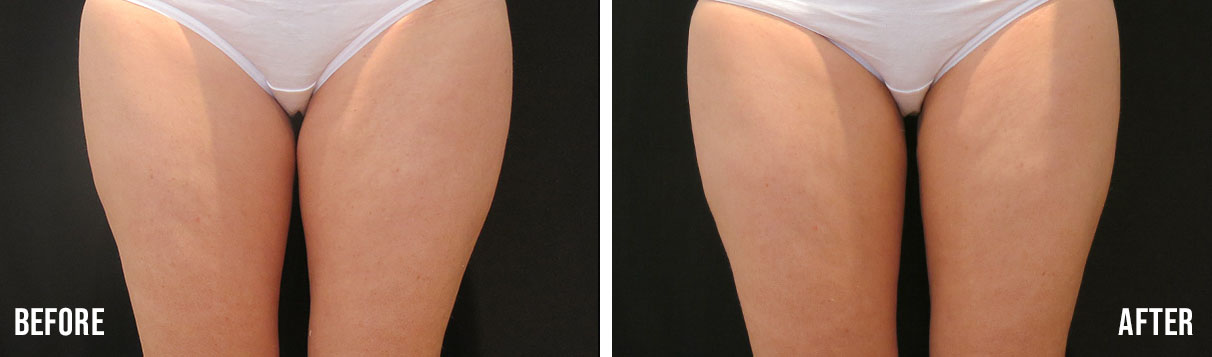 coolsculpting thighs before and after cincinnati ohio