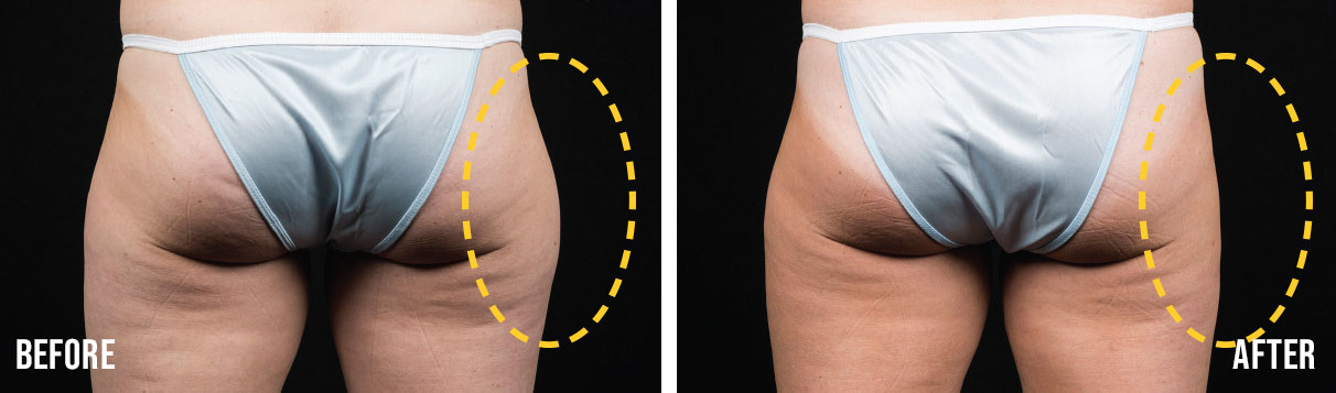 coolsculpting thighs before and after cincinnati
