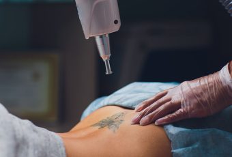 How Painful is Laser Tattoo Removal?