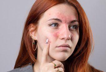 Managing Rosacea: Effective Treatments to Reduce Redness