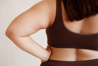 Can Liposuction Remove Arm Fat?
