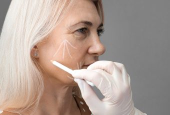 How Many Years Does a Thread Lift Last?