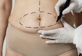 How Many Years Does a Tummy Tuck Last?
