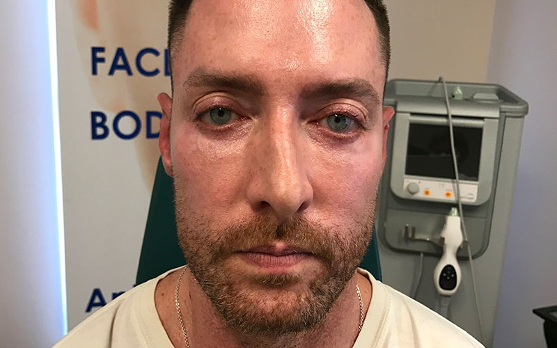 ba15.jpg Laser face treatment Cincinnati