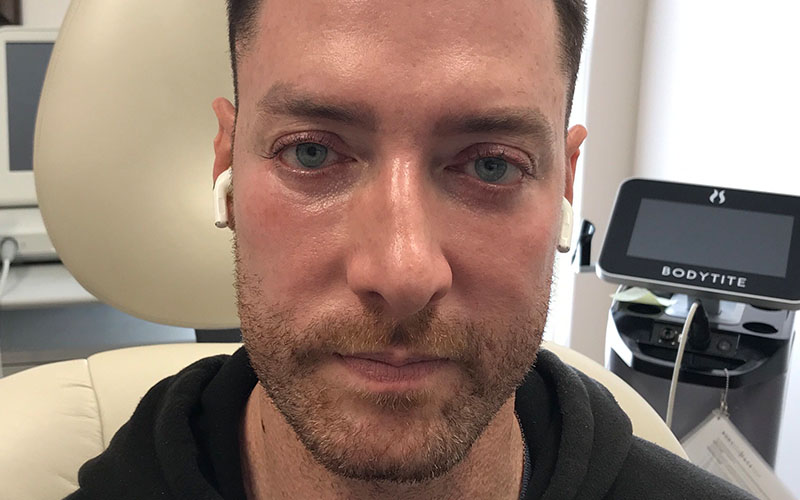 Laser face treatment