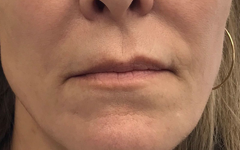 ba21.jpg Face Treatments in Cincinnati