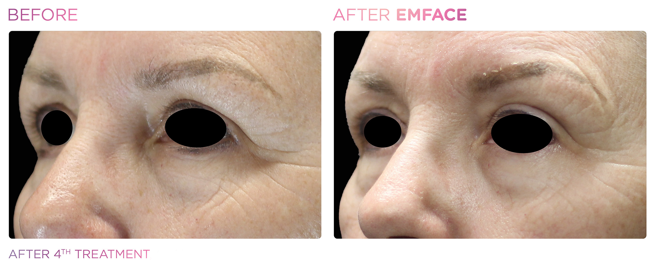 emface-before-after-results11