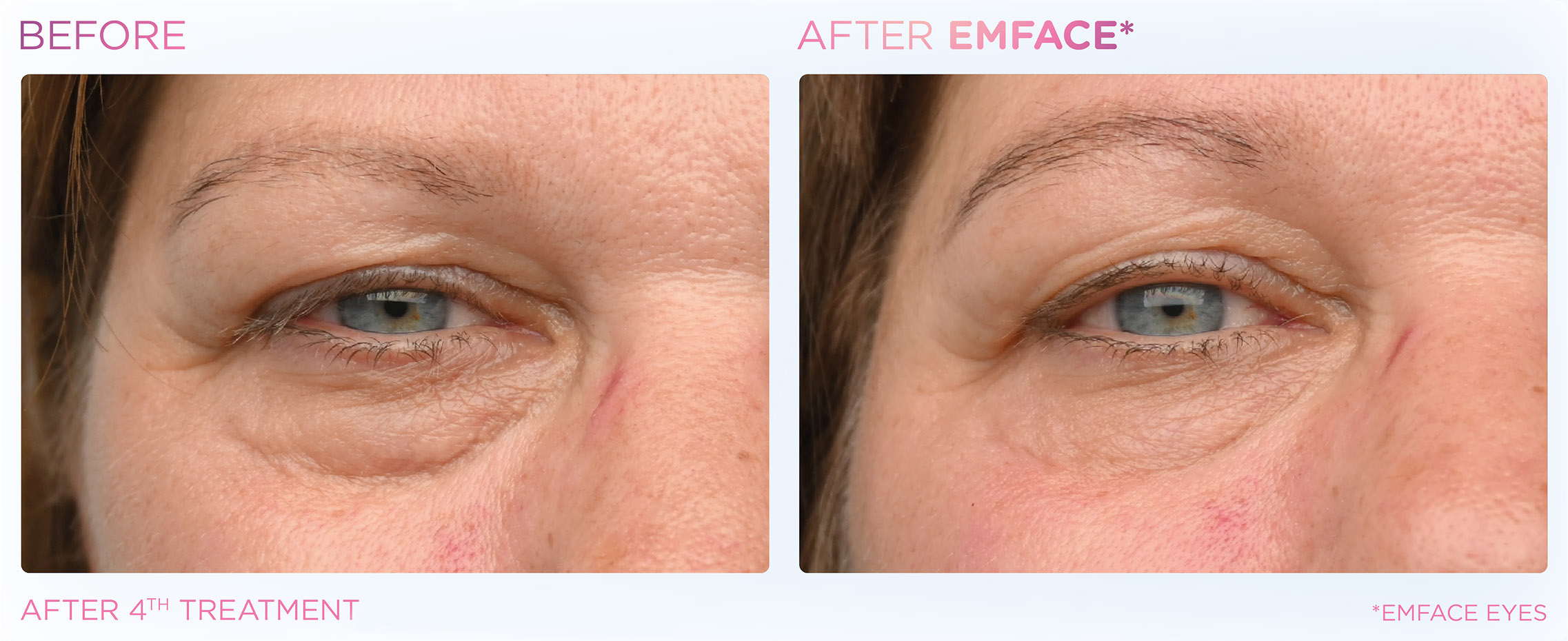 emface-before-after-results3