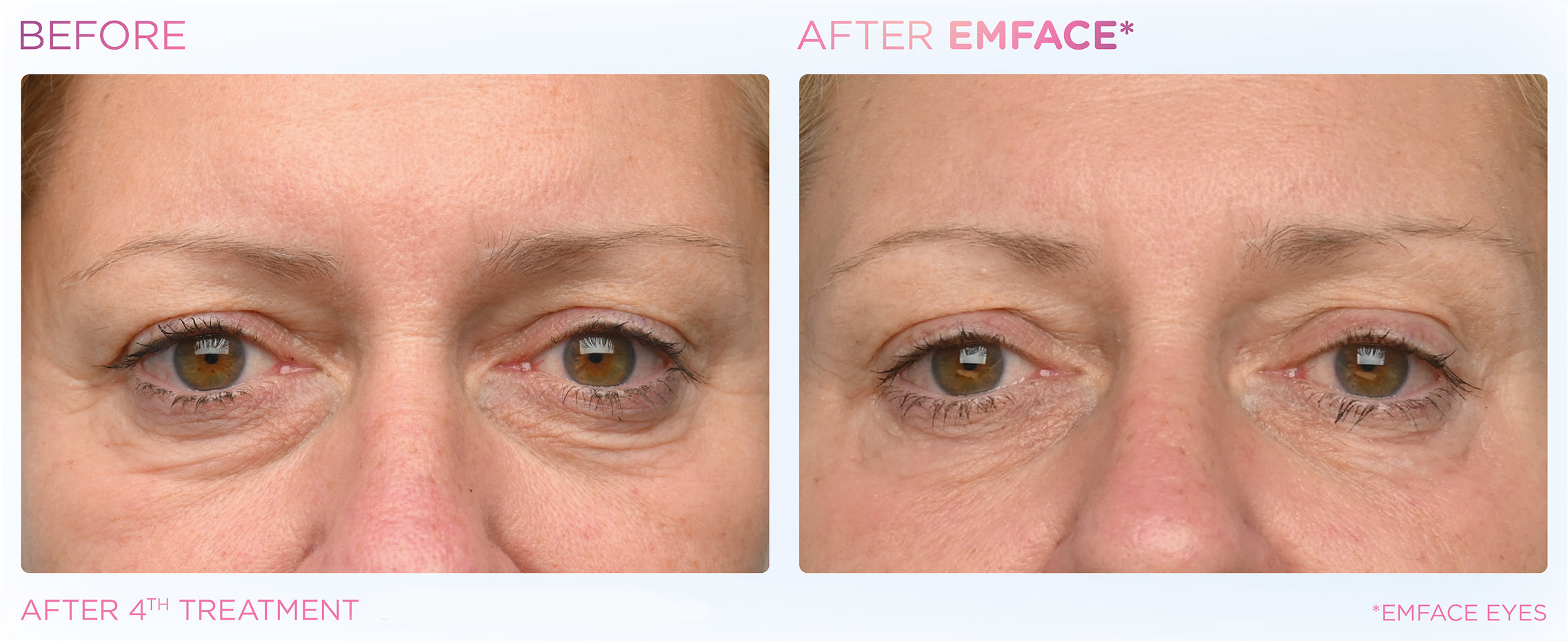 emface-before-after-results4