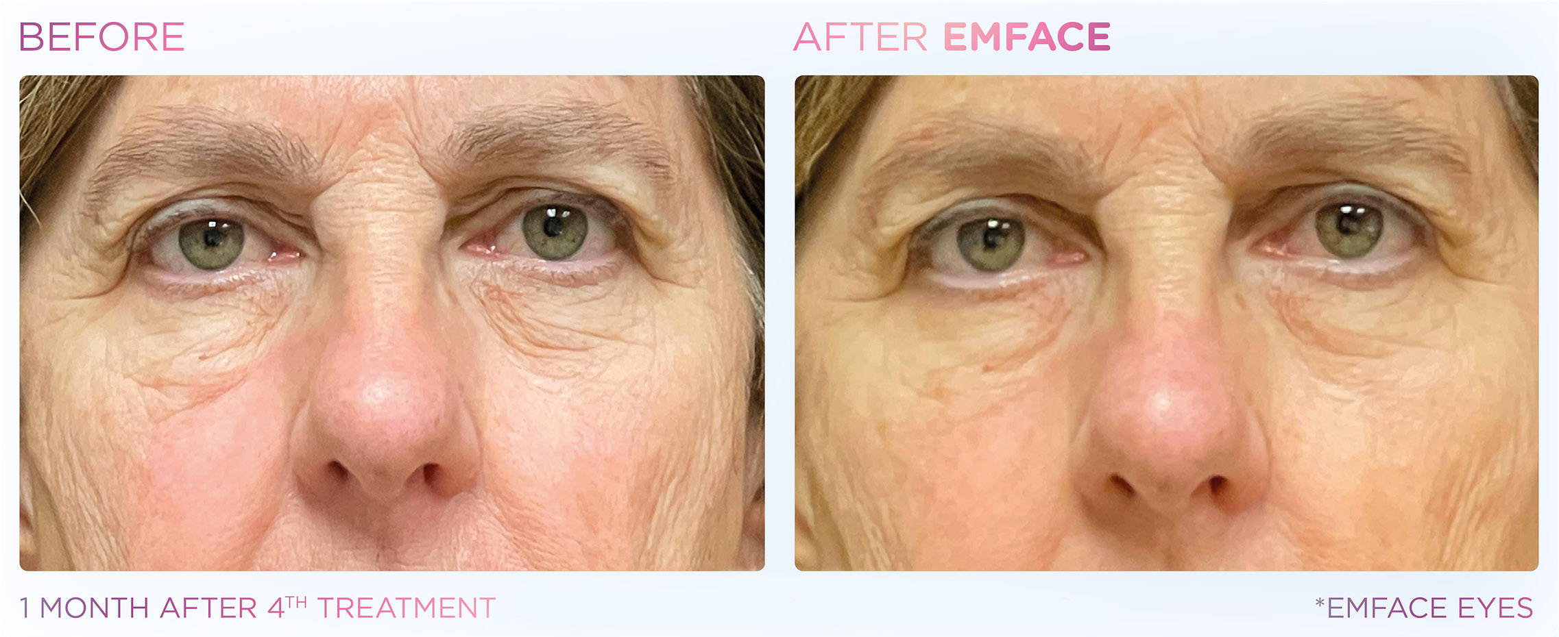 emface-before-after-results5