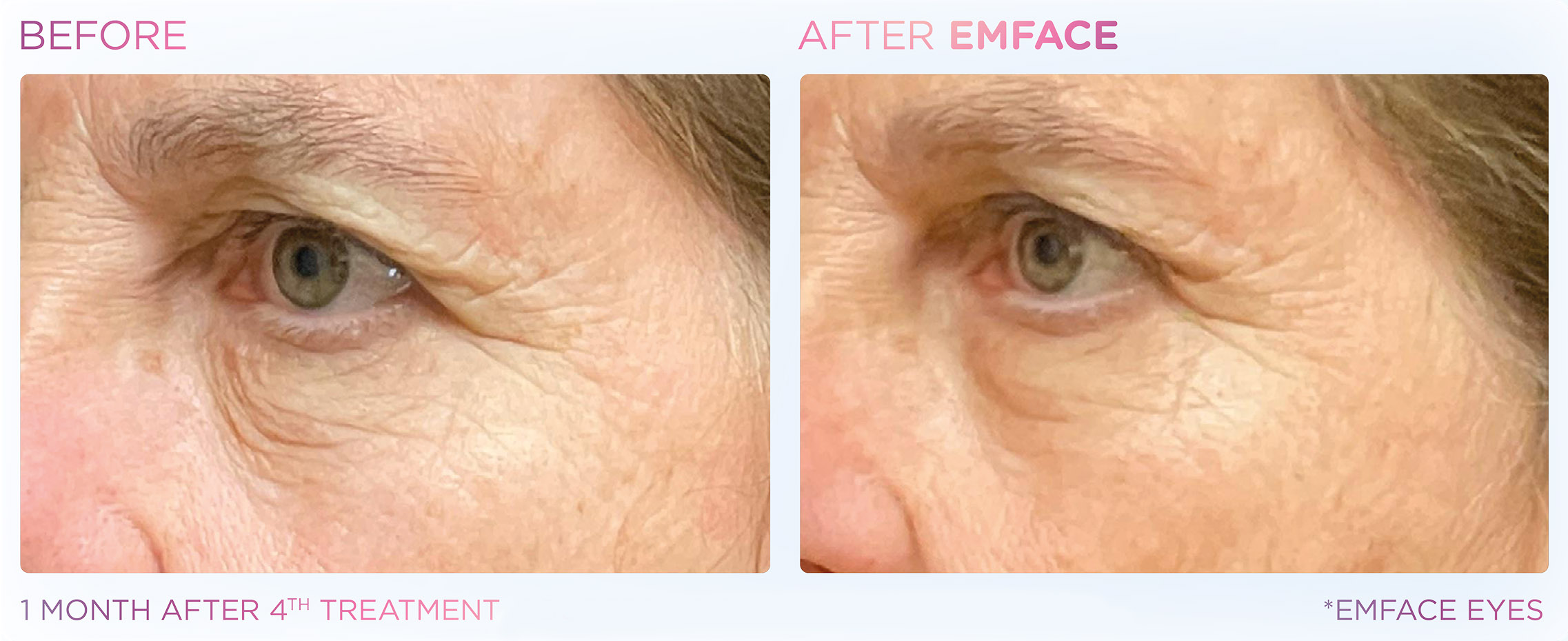 emface-before-after-results6