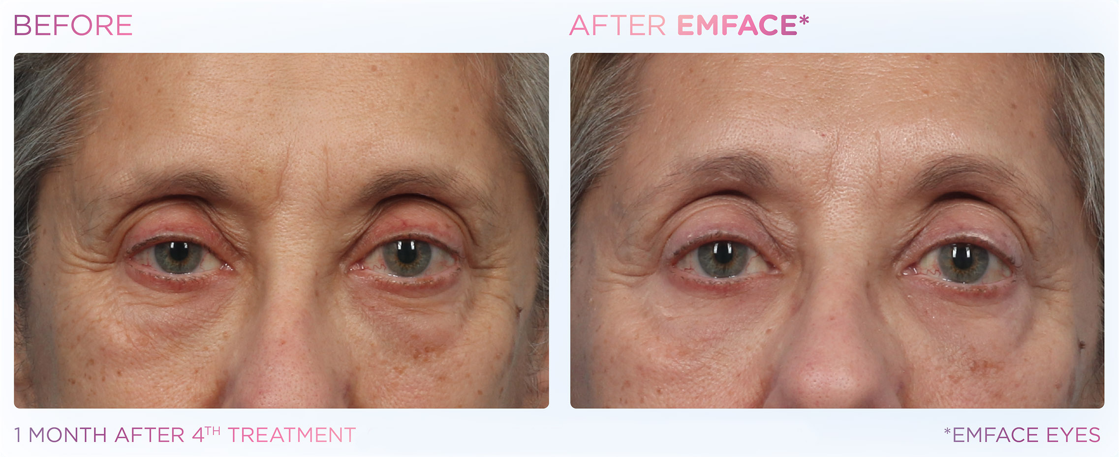 emface-before-after-results7
