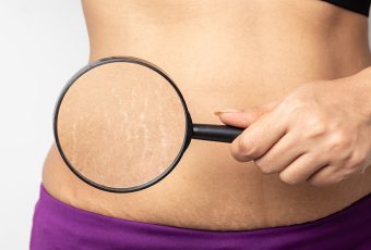 How Painful is Stretch Mark Removal?