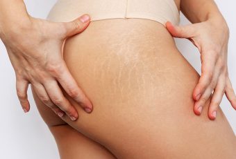 How to Get Rid of Stretch Marks: Effective Treatment Options in Cincinnati, Ohio