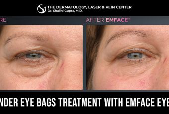 Under Eye Bags Treatment Near Me – EMFACE Eyes