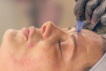 What Can Microneedling Treat?