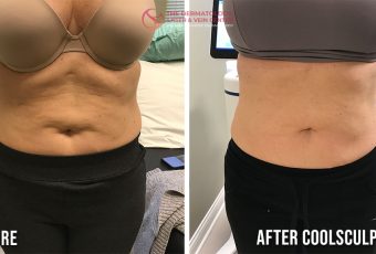 Fat Removal with CoolSculpting in Cincinnati, Ohio