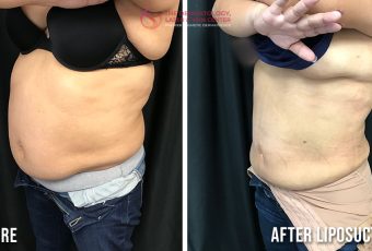 Fat Removal with Liposuction | Fat Removal Near Me in Cincinnati, Ohio