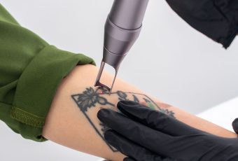 Best Laser Tattoo Removal Clinic in Cincinnati – Safe, Effective Ink Removal