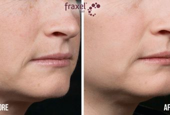 What Can Fraxel Laser Treat?