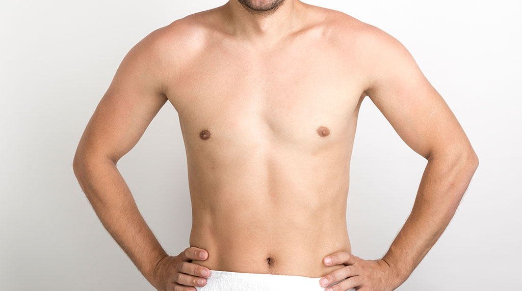 Gynecomastia