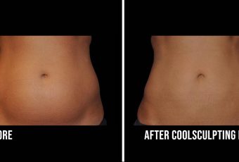 How to Get Rid of Stomach Fat | CoolSculpting Elite Treatment
