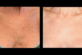 How to Reverse Sun Damage and Brown Spots with BBL Laser Treatment