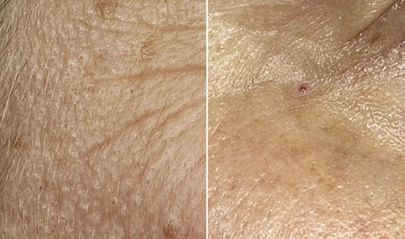 fraxel before and after cincinnati ohio